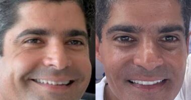Artigo: Aos 45 anos, ACM Neto faz procedimentos estéticos no rosto e surpreende aliados